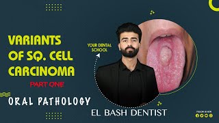 variants of squamous cell carcinoma 1  oral pathology  عزت شومان [upl. by Donnamarie]