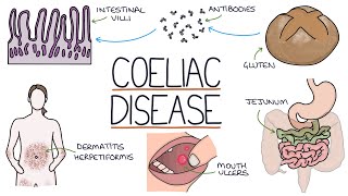 Understanding Coeliac Disease [upl. by Ertemed]