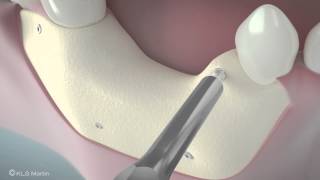 SonicWeld Rx® Dental – Shell technique for vertical defect augmentation [upl. by Ayanet]