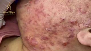 Remove inflammatory acne pustules for young girls 215  Loan Nguyen [upl. by Bambi]