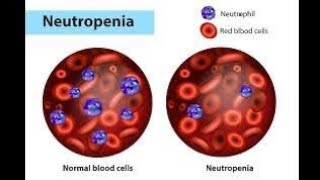 NEUTROPENIA  Definition of neutropenia  Causes of neutropenia [upl. by Phionna]