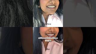 I got my teeth WHITENED beautyhacks makeup toronto beautyhacks teethwhitening [upl. by Drwde]