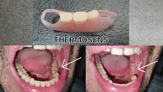 THERMOSENS DENTURES аСм [upl. by Eizus219]