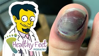 DOCTOR REMOVES NAIL WITH NO NUMBING MEDS [upl. by Ettevad]