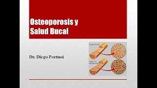 Osteoporosis y Salud Bucal [upl. by Aitan]