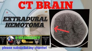 linear undisplaced fracture of parietal bone ct brain [upl. by Nerval]