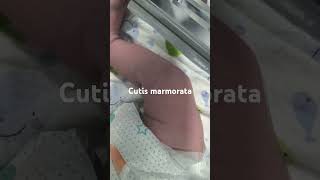 Cutis marmoratanewborn paeds clinical [upl. by Antonetta117]