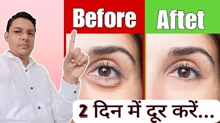 आंखों की सूजन कैसे ठीक करें  How to get Rids of Puffy eyes  Eye Bags Treatments [upl. by Filemon]