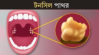 টনসিল পাথর  Tonsil Stone  3D Animation [upl. by Blase]