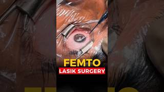 Live Femto Lasik Surgery [upl. by Enyawal]