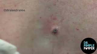 8 Minutes of Satisfying Soft Pops Dr Pimple Popper POPS All Over The Body [upl. by Sprague]