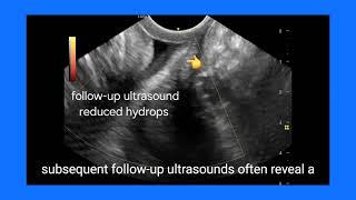 Understanding Cervical Hydrops Ultrasound Findings FollowUp Causes and Treatment Explained [upl. by Roberta]