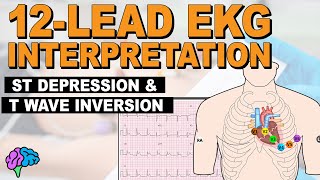 Myocardial Ischemia  ST Depression amp T Wave Inversion  12lead EKG [upl. by Aivilo626]