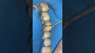 Old MetalCeramic Crown removal under rubber dam isolation [upl. by Nitnelav]