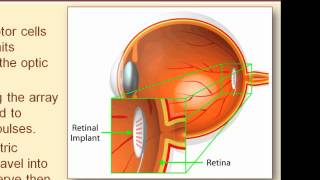 The Workings of the Retinal Prosthesis [upl. by Babbie]