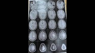 Resection of a parasagittal Meningioma [upl. by Thornton]