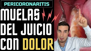 MUELA del JUICIO SALIENDO con dolor e inflamada  Así se ve una PERICORONARITIS [upl. by Maurer555]