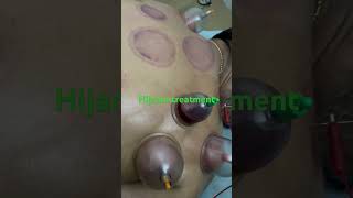 Hijama treatment all chronic disease 100cure [upl. by Parnas]