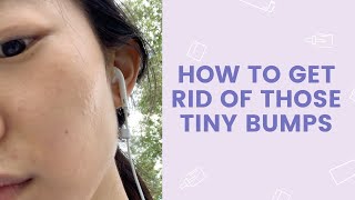 How to Get Rid of Those Tiny Bumps  FaceTory [upl. by Saum]