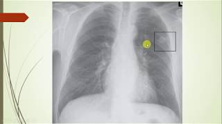 Histoplasmosis a clinical case based review geography symptoms differential diagnosis treatment [upl. by Anwahsit]