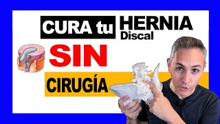 ✅cómo Curar una HERNIA Discal SIN cirugía ❌ [upl. by Changaris]