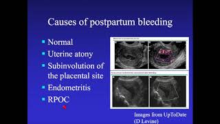 Retained Products of Conception [upl. by Norihs]