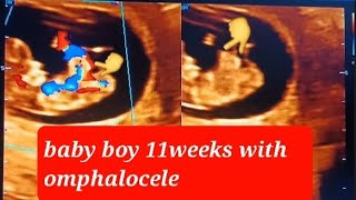 baby boy 11weeks with omphalocele ultrasound babyboy omphalocele subscribe [upl. by Bonis210]