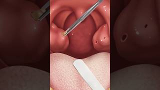 ASMR remove tonsil stone treatment Tonsil stone removal from deep hole 2d animation [upl. by Mera541]