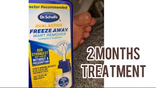 How to remove warts with Dr Scholls Dual Action I Freeze away wart remover common amp plantar [upl. by Laroy]