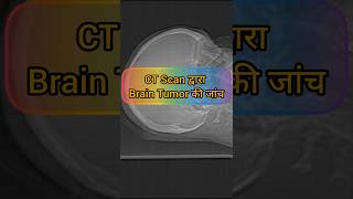 CT Scan द्वारा Brain Tumor Ki जाँचNCCT HEAD anatomy neetmotivation [upl. by Hayifas]