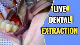 76 Extraction of abscessed wisdom tooth and decayed second molar [upl. by Lexis201]