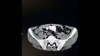 Tuberculosis involving terminal ileum ileocecal junction caecum and ascending colon [upl. by Desdamonna]