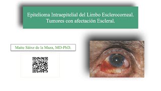 Epitelioma Intraepitelial del Limbo Esclerocorneal Tumores con afectación Escleral [upl. by Ailimat]