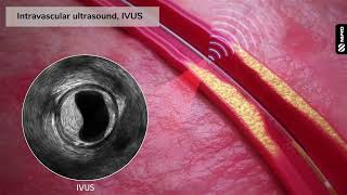 MK0062rA IVUS  NIRS Animation HD 1080p [upl. by Ailahtan137]