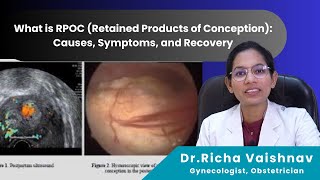 What is RPOC Retained Products of Conception Causes Symptoms and Recovery  Dr RIcha Vaishnav [upl. by Aronow]