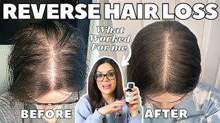 4 Best Natural Home Remedies to Prevent from Your Hair Loss Permanently  Hair Loss Treatment [upl. by Erbas804]