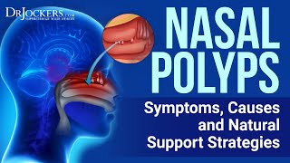 Top 12 Natural Remedies for Nasal Polyps [upl. by Keverian]