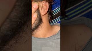 Beard hair asmr ingrown hairissue barber ingrownhairremoval nails hairproblem hair [upl. by Ciapha377]