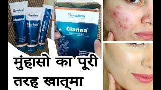 Himalaya Clarina ANTI ACNE KIT Review  Hindi  हिंदी [upl. by Aihsemek366]