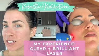 MY EXPERIENCE CLEAR AND BRILLIANT LASER FOR MELASMA HYPERPIGMENTATION [upl. by Tnemelc]