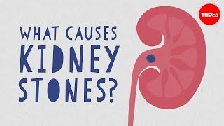 What causes kidney stones  Arash Shadman [upl. by Berkley]