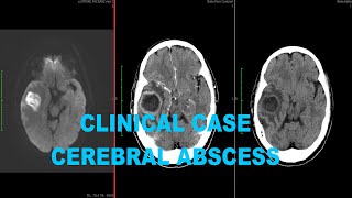 Clinical Case Cerebral abscess on CT and MRI [upl. by Bradlee]