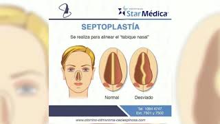 Septoplastia y Rinoseptoplastia [upl. by Derag]