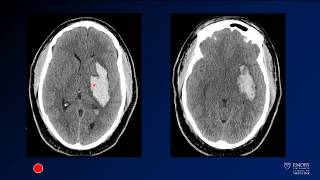 Imaging intracranial hemorrhage  Case 1  Hypertensive hemorrhage [upl. by Halette]