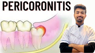 Pericoronitis Causes  Treatment [upl. by Enailil]