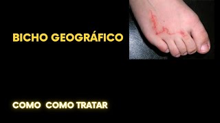 Bicho geográfico como tratar [upl. by Nyvrem]