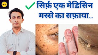 Best Medicine for warts  चेहरे के मस्सेगर्दन के मस्से DrJamil Ahmed Shah [upl. by Ycart]