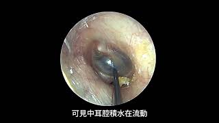 中耳積水執行耳膜穿刺抽吸。 Tympanic aspiration for a patient of otitis media with effusion [upl. by Nylac]