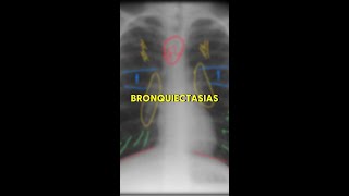 Bronquiectasias no RX [upl. by Efioa42]