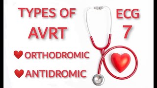 AVRT TYPES ORTHODROMIC AND ANTIDROMIC [upl. by Gleich]